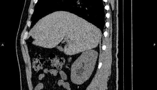 Adrenal myelolipoma (Radiopaedia 84321-99619 Sagittal non-contrast 31).jpg