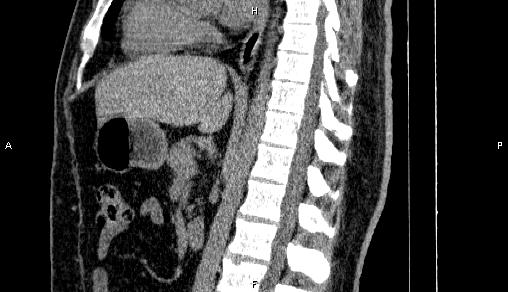 File:Adrenal myelolipoma (Radiopaedia 84321-99619 Sagittal non-contrast 56).jpg