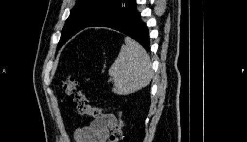 Adrenal myelolipoma (Radiopaedia 84321-99619 Sagittal non-contrast 93).jpg