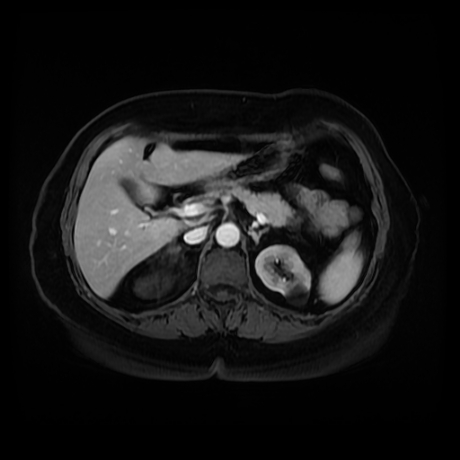 Adrenal myelolipoma - MRI (Radiopaedia 83249-97646 T1 fat sat arterial phase 32).jpg