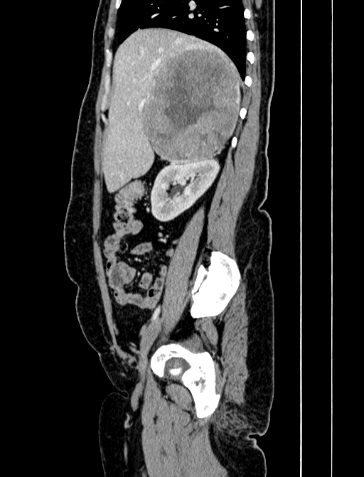 Adrenocortical carcinoma (Radiopaedia 87281-103569 Sagittal C+ portal venous phase 84).jpg