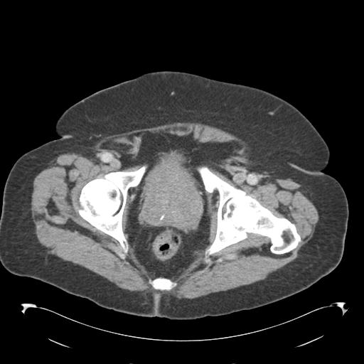 Adult ileal intussusception with secondary obstruction (Radiopaedia 30395-31051 Axial C+ portal venous phase 74).jpg
