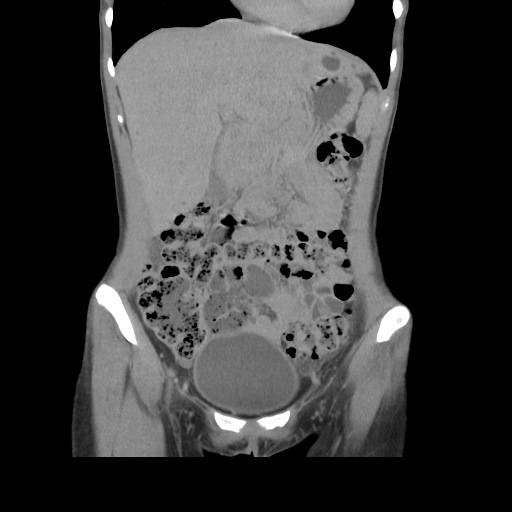 File:Adult polycystic kidney disease (Radiopaedia 48845-53876 Coronal renal excretory phase 13).jpg