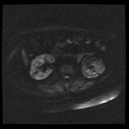Adult polycystic kidney disease (Radiopaedia 59075-66365 Axial DWI 44).jpg