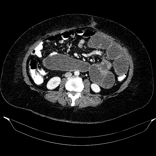 Afferent loop syndrome - secondary to incarcerated trocar site hernia (Radiopaedia 82959-97305 Axial C+ portal venous phase 120).jpg