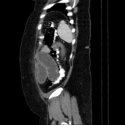 Afferent loop syndrome - secondary to incarcerated trocar site hernia (Radiopaedia 82959-97305 Sagittal C+ portal venous phase 20).jpg