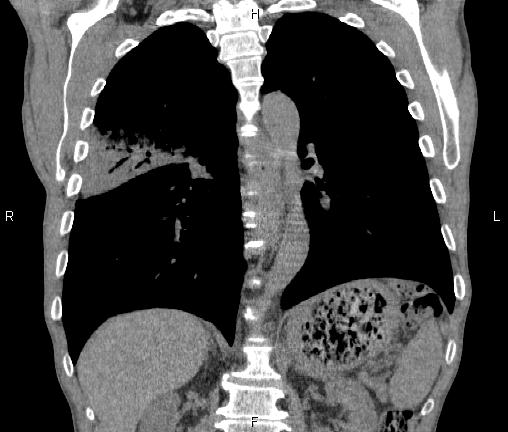 Air bronchogram in pneumonia (Radiopaedia 85719-101512 Coronal non-contrast 37).jpg