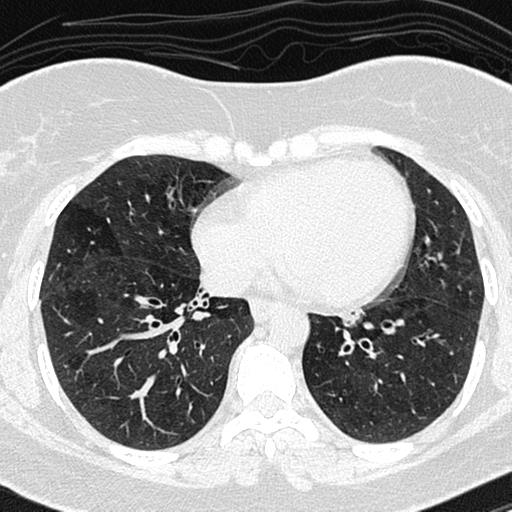 File:Air trapping in small airway disease (Radiopaedia 61685-69694 Axial lung window 113).jpg