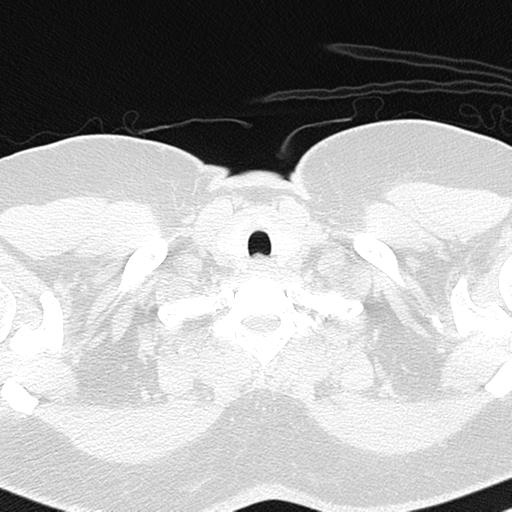 File:Air trapping in small airway disease (Radiopaedia 61685-69694 Axial lung window 3).jpg