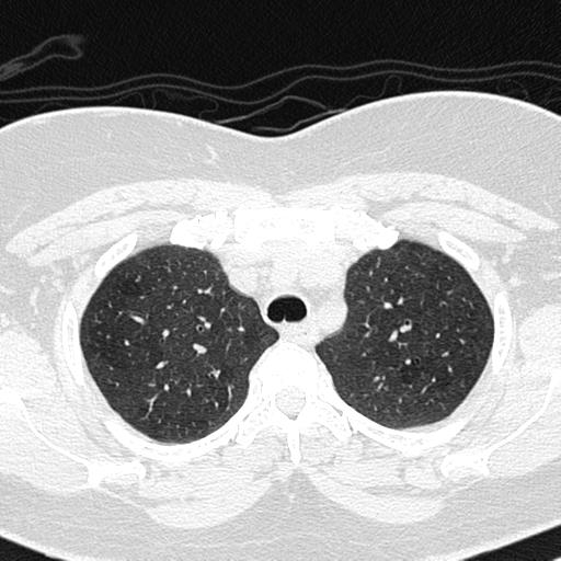 File:Air trapping in small airway disease (Radiopaedia 61685-69694 Axial lung window 38).jpg