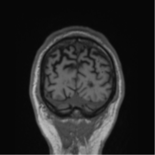 Alzheimer's disease- with Gerstmann syndrome and dressing apraxia (Radiopaedia 54882-61150 Coronal T1 11).png