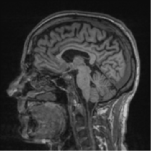 File:Alzheimer's disease- with apraxia (Radiopaedia 54763-61011 Sagittal T1 38).png