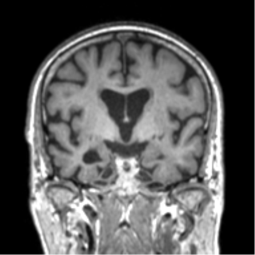 Alzheimer disease and cerebral amyloid angiopathy (Radiopaedia 64234-73011 Coronal T1 37).png