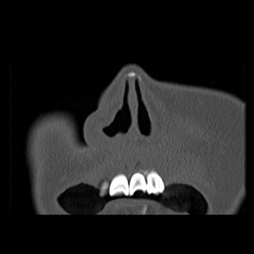 File:Ameloblastic fibro-odontoma (Radiopaedia 18843-18780 B 3).jpg