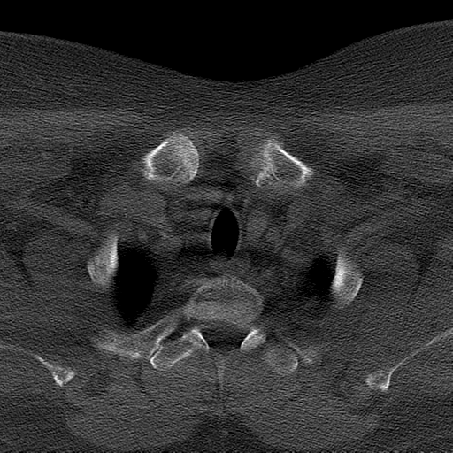Ameloblastoma (Radiopaedia 38520-40623 Axial bone window 74).png