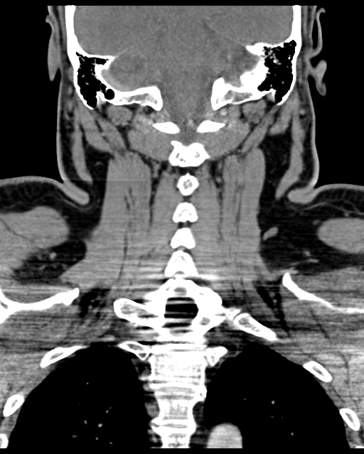 Ameloblastoma (Radiopaedia 38520-40623 Coronal non-contrast 54).png
