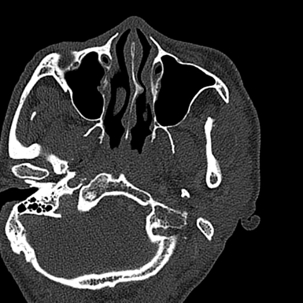 Ameloblastoma (Radiopaedia 51921-57766 Axial bone window 137).jpg