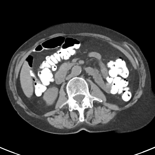 File:Ampullary adenocarcinoma (Radiopaedia 34013-35237 Axial non-contrast 28).png