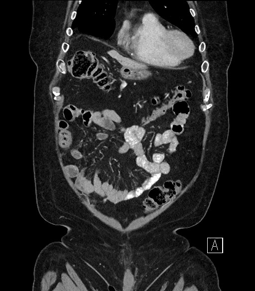 Ampullary adenocarcinoma (Radiopaedia 59373-66734 D 16).jpg