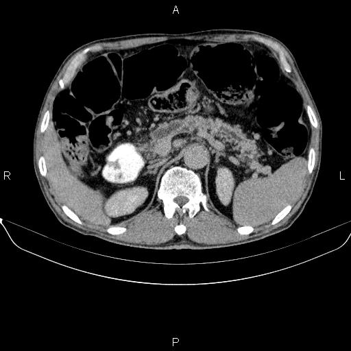 Ampullary adenocarcinoma (Radiopaedia 86093-102032 Axial C+ delayed 30).jpg