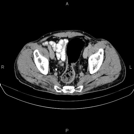 Ampullary adenocarcinoma (Radiopaedia 86093-102032 Axial C+ delayed 91).jpg