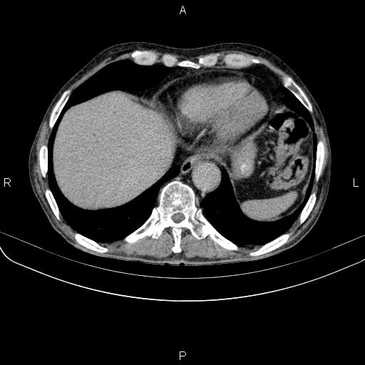Ampullary adenocarcinoma (Radiopaedia 86093-102033 Axial C+ delayed 14).jpg