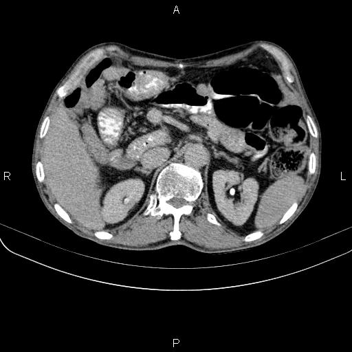 Ampullary adenocarcinoma (Radiopaedia 86093-102033 Axial C+ delayed 38).jpg