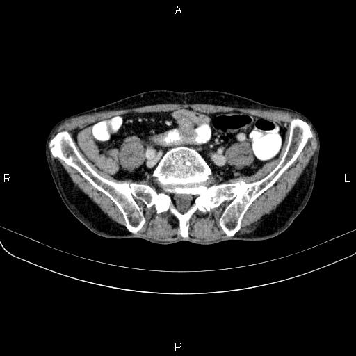 Ampullary adenocarcinoma (Radiopaedia 86093-102033 B 89).jpg