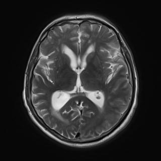 File:Amyloid angiopathy with inflammation (Radiopaedia 30360-31002 Axial T2 17).jpg