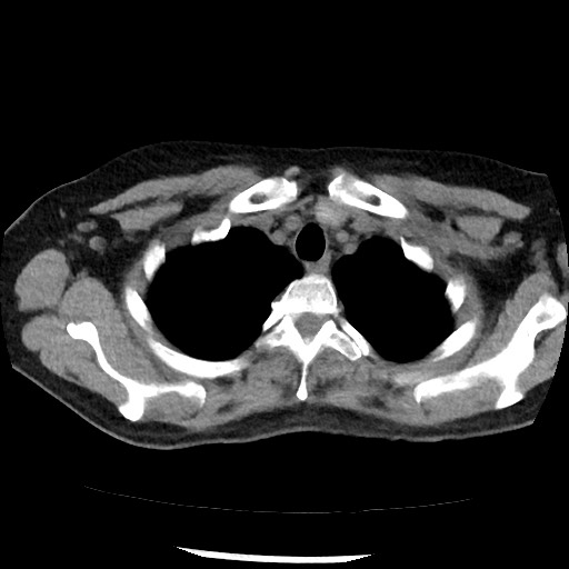 Amyloidosis - bronchial and diffuse nodular pulmonary involvement (Radiopaedia 60156-67744 Axial non-contrast 9).jpg