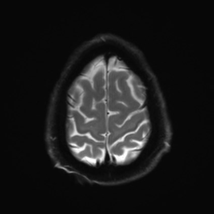 File:Amyotrophic lateral sclerosis (Radiopaedia 87352-103658 Axial DWI 25).jpg