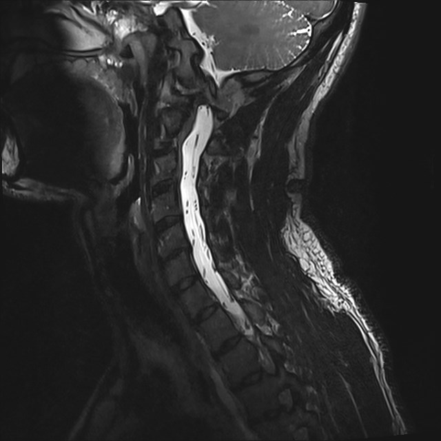 Amyotrophic lateral sclerosis (Radiopaedia 87352-103658 I 43).jpg