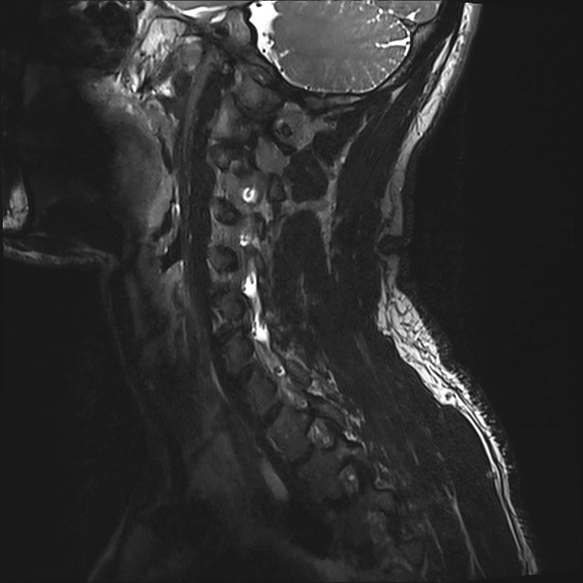 Amyotrophic lateral sclerosis (Radiopaedia 87352-103658 I 48).jpg