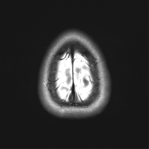 File:Anaplastic astrocytoma - thalamic glioma (Radiopaedia 59709-67115 Axial T2 35).png