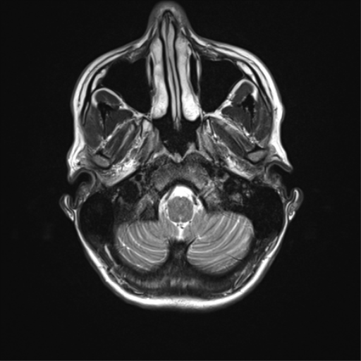 File:Anaplastic astrocytoma IDH mutant (Radiopaedia 50046-55341 Axial T2 6).png
