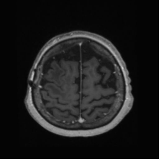 File:Anaplastic astrocytoma IDH wild-type (pseudoprogression) (Radiopaedia 42209-45278 Axial T1 C+ 126).png