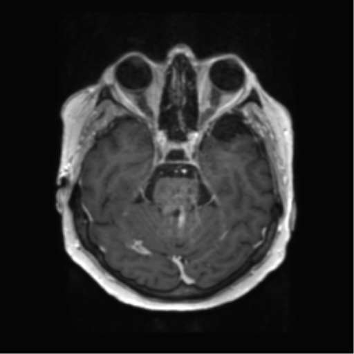 File:Anaplastic astrocytoma IDH wild-type (pseudoprogression) (Radiopaedia 42209-45279 Axial T1 C+ 49).png