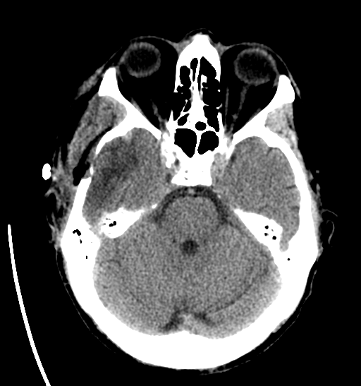 File:Anaplastic meningioma with recurrence (Radiopaedia 34452-35786 Axial non-contrast 11).png