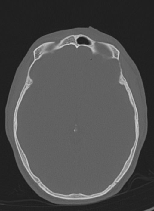 Anaplastic oligodendroglioma with skull fracture (Radiopaedia 74831-85846 Axial bone window 37).png