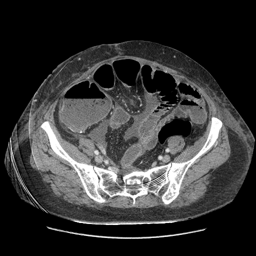 Anastomosis leak at ileostomy closure site (Radiopaedia 82138-96184 B 178).jpg