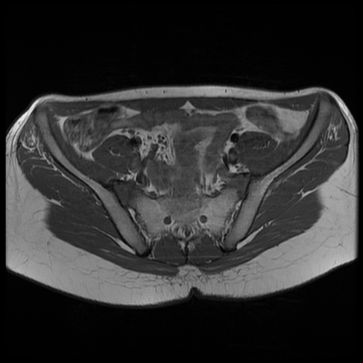 File:Androgen insensitivity syndrome (Radiopaedia 38585-40727 Axial T1 5).jpg