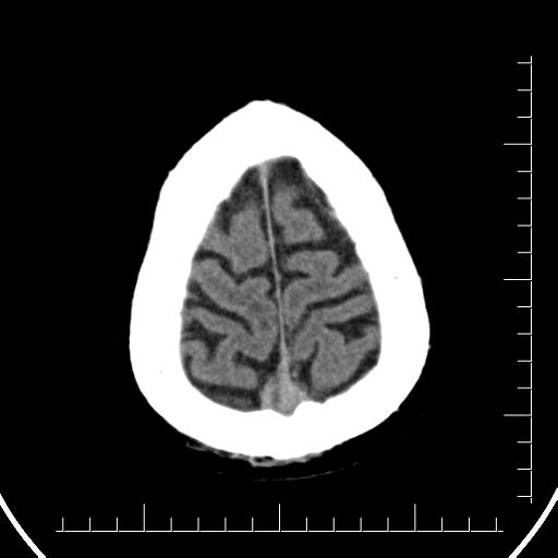 Aneurysm of posterior communicating artery (Radiopaedia 20188-20162 Axial non-contrast 44).jpg