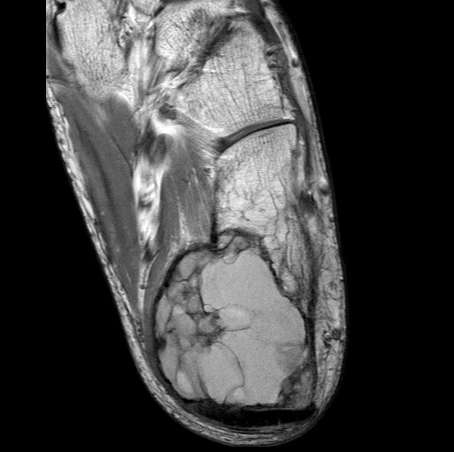 File:Aneurysmal bone cyst of the calcaneus (Radiopaedia 60669-68420 Axial PD 9).jpg