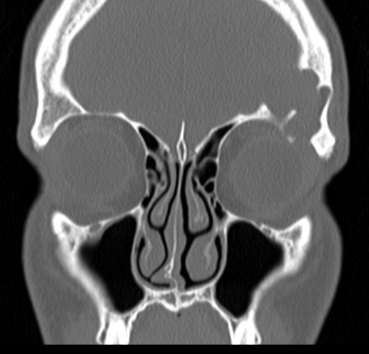 Angular epidermoid cyst (Radiopaedia 46908-51439 Coronal bone window 24).png
