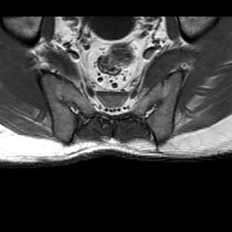 File:Ankylosing spondylitis with zygapophyseal arthritis (Radiopaedia 38433-40517 B 11).jpg