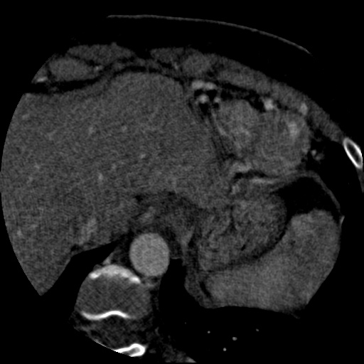 File:Anomalous left coronary artery from the pulmonary artery (ALCAPA) (Radiopaedia 40884-43586 A 83).jpg