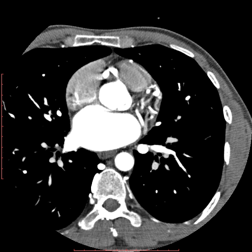 File:Anomalous left coronary artery from the pulmonary artery (ALCAPA) (Radiopaedia 70148-80181 A 128).jpg