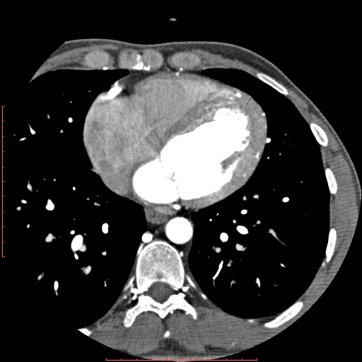 Anomalous left coronary artery from the pulmonary artery (ALCAPA) (Radiopaedia 70148-80181 A 227).jpg