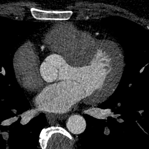 File:Anomalous origin of the left coronary artery with malignant course (Radiopaedia 77842-90126 C 118).jpeg