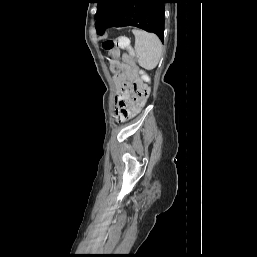 Anorectal carcinoma (Radiopaedia 44413-48064 C 97).jpg